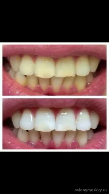 Студия косметического отбеливания зубов White&Smile