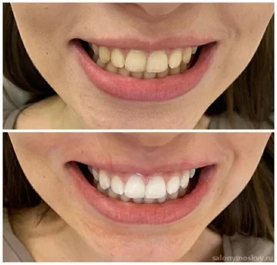 Студия косметического отбеливания зубов BeautySmile